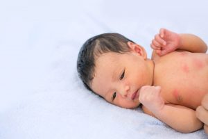 Jenis Gatal Pada Bayi Dan Cara Mengatasinya